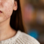 Обличчя в запалених прищах